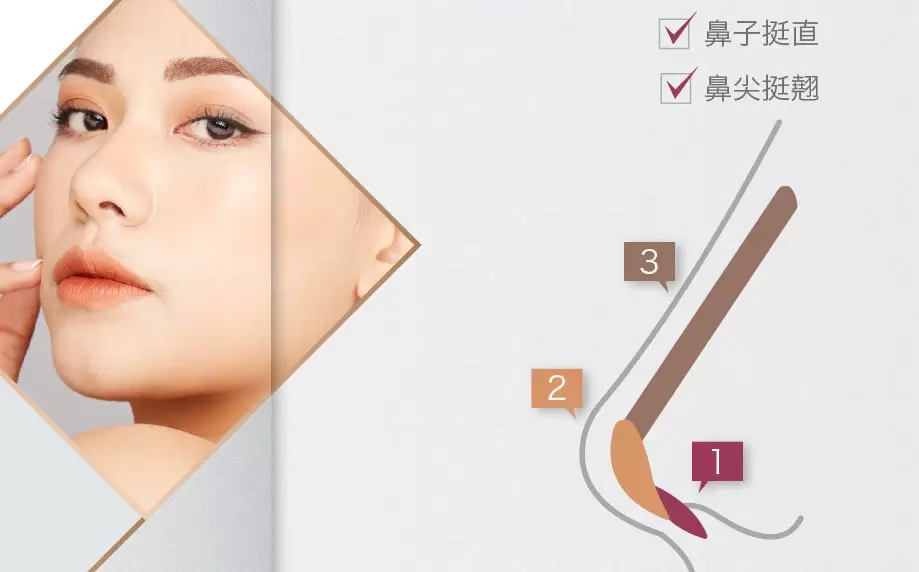 鼻形雕塑/鼻部整形/隆鼻重建