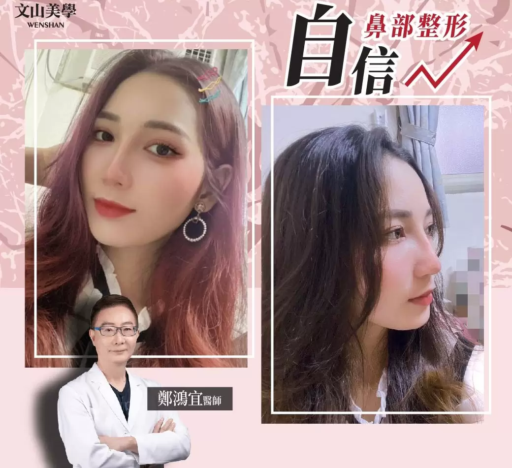 鼻子是五官立體的關鍵 高雄整形外科 鄭鴻宜醫師