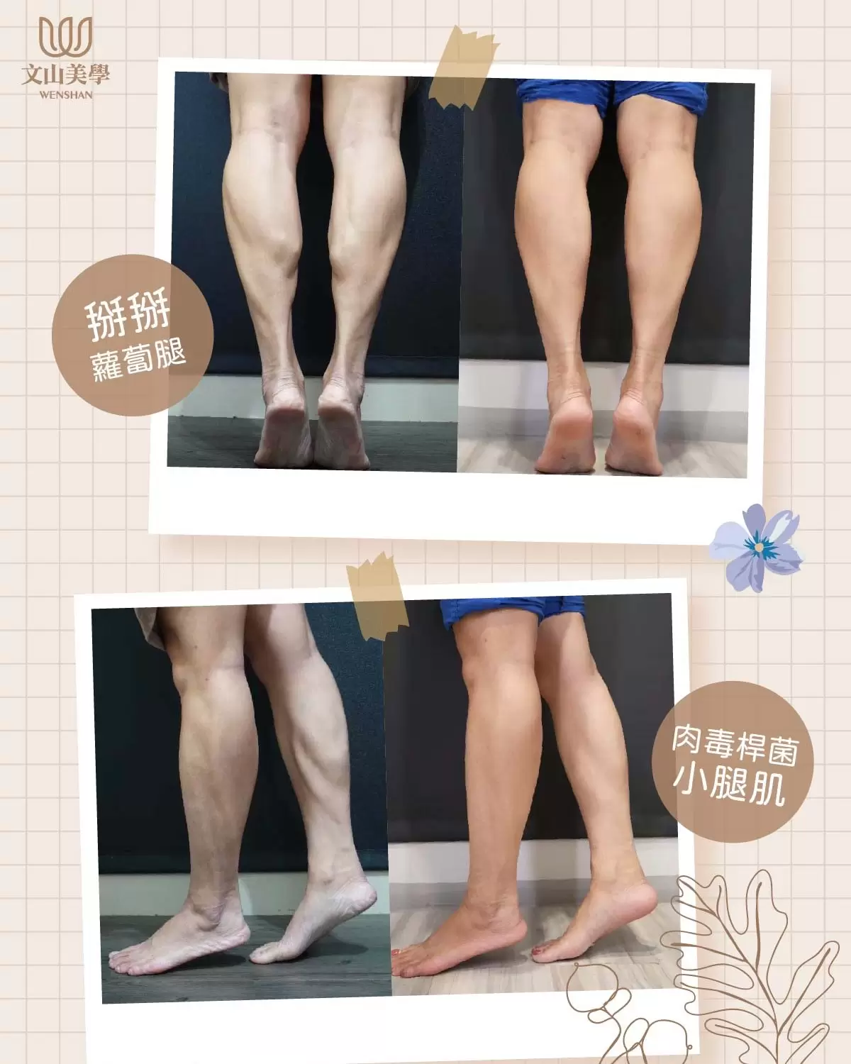 『肉毒桿菌』來助我們拔蘿蔔一臂之力 院內案例