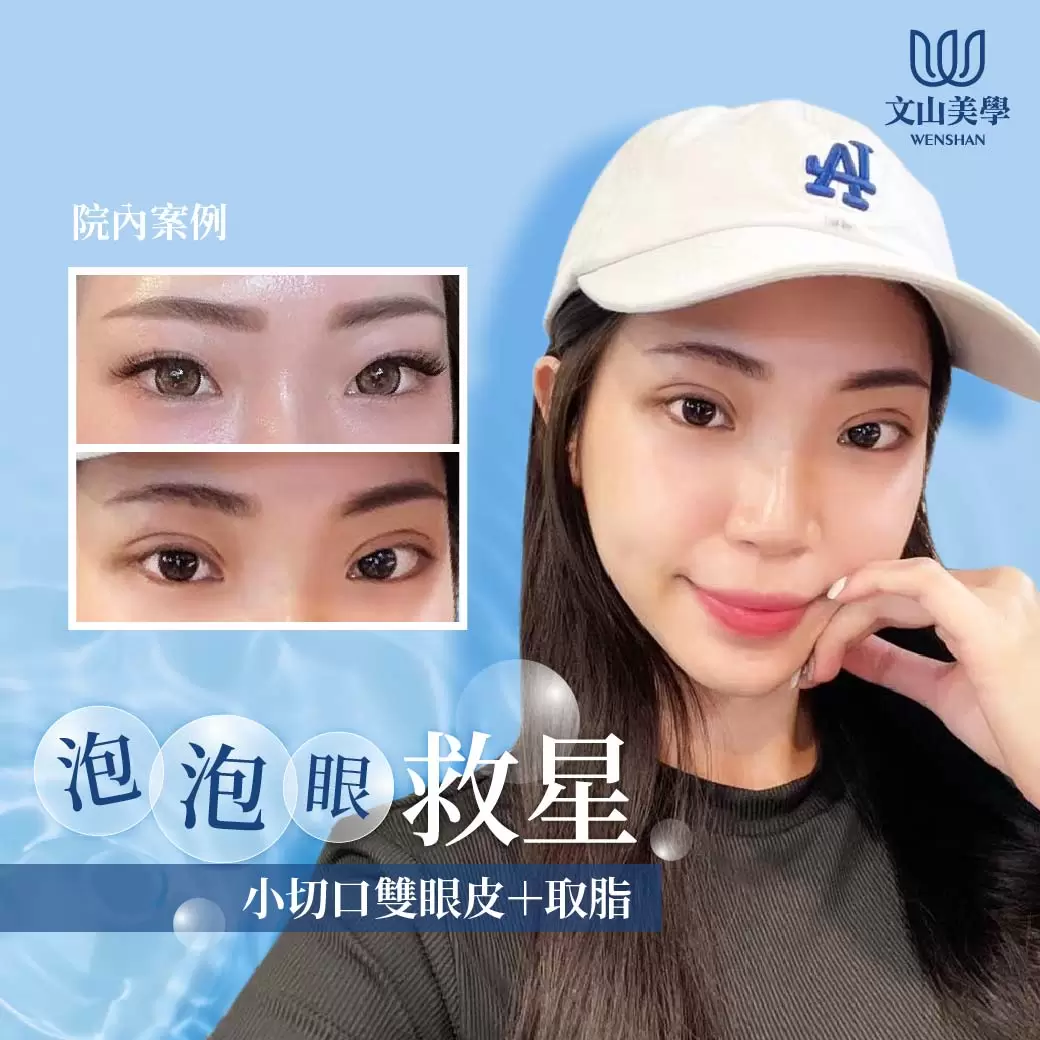 泡泡眼美眉的救星 院內案例【小切口雙眼皮＋取脂】