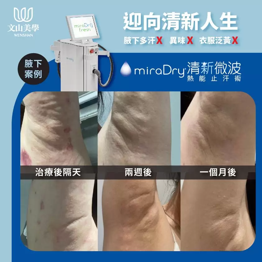 清新微波 案例分享 腋下多汗 異味 衣服泛黃