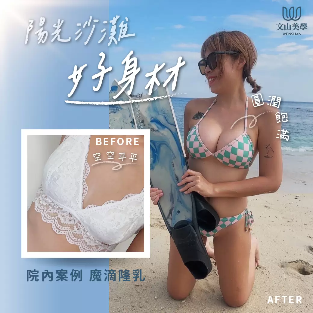 今年夏天我圓夢了 高雄整形外科院內案例 魔滴隆乳