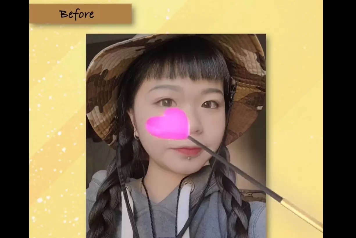 掰掰蒜頭鼻 晉升甜美妞 高雄整形外科 三段式隆鼻＋縮鼻翼 院內案例