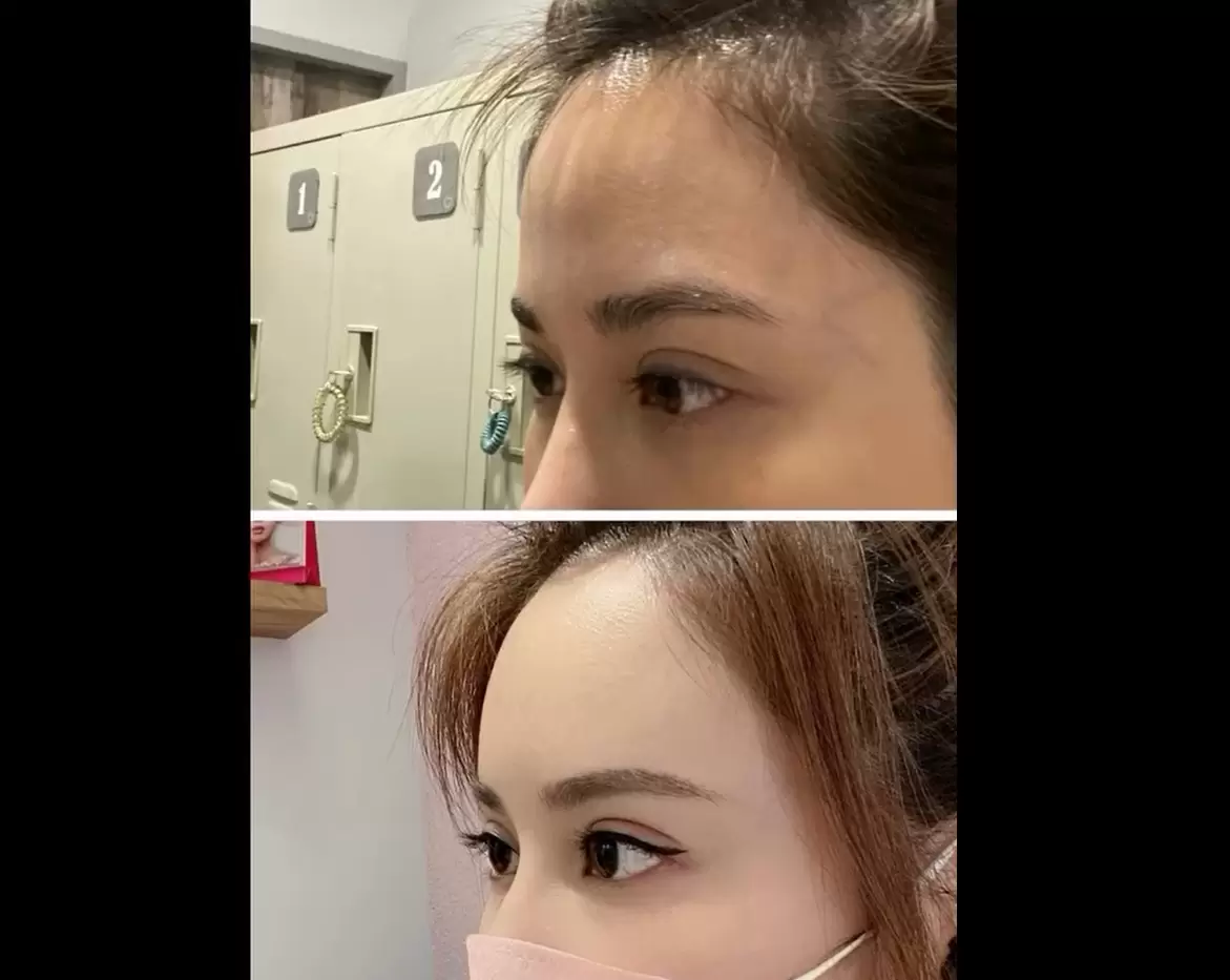 Ellansé洢蓮絲客製化豐額融合玻尿酸和膠原蛋白增生劑精緻輪廓從額頭開始