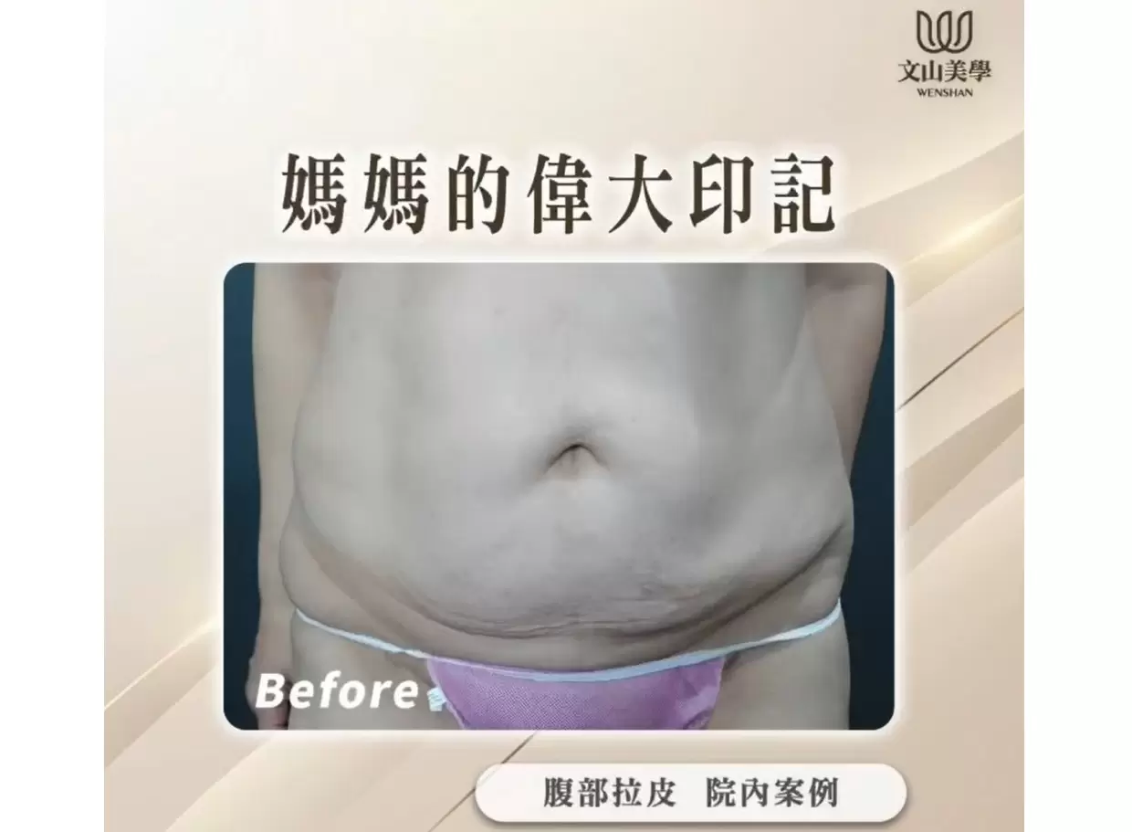 高雄整形外科院內案例 媽媽的偉大印記 腹部拉皮手術