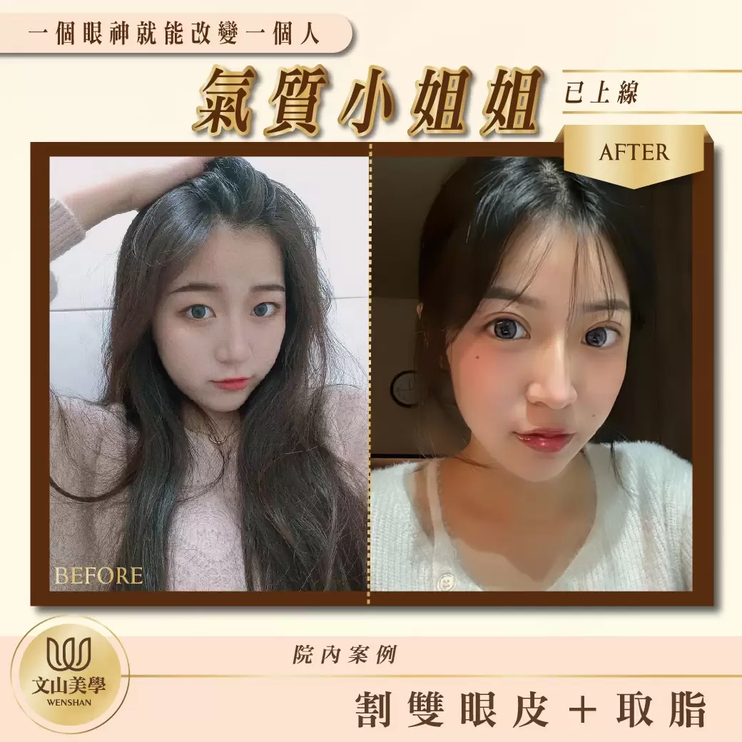高雄整形外科院內案例 客製化專屬於妳的雙眼皮＋取脂