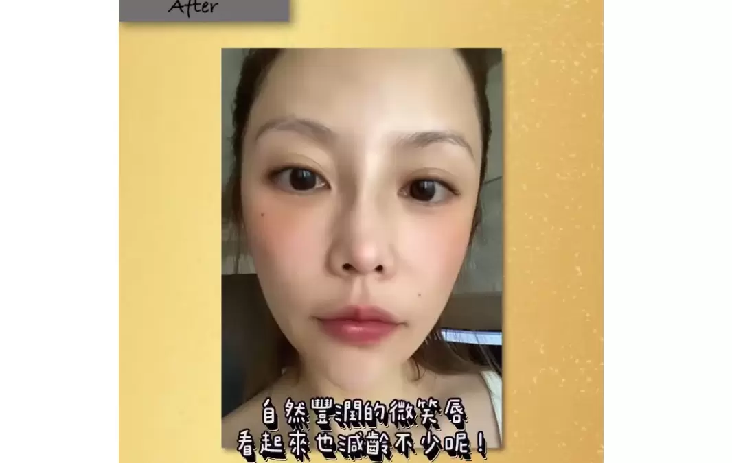 性感減齡嘟嘟微笑唇讓人忍不住想多親幾下 玻尿酸豐唇院內案例 