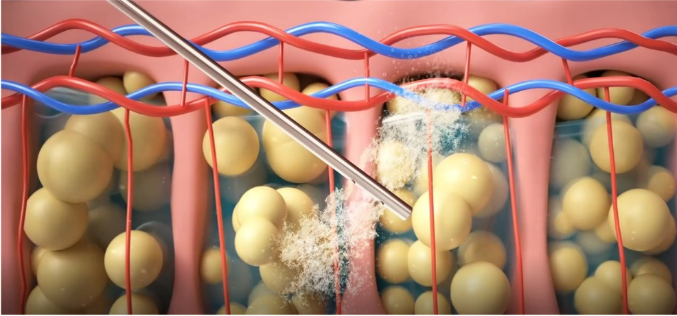 注⼊腫脹麻醉液，軟化脂肪組織
