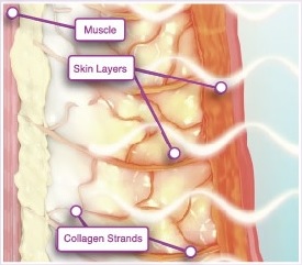 將熱能傳導至真皮層和皮下組織,高雄鳳凰電波,(俗稱)鳳凰電波thermage FLX&reg;療程