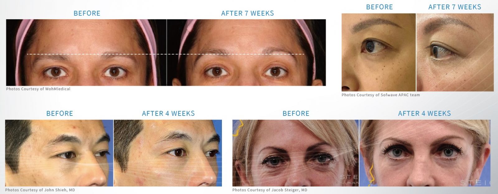 適合高雄索夫波療程的眉眼鬆弛無神，臉部皺紋、頸紋，下半臉輪廓線模糊，雙下巴、嘴邊肉明顯，皮膚觸感鬆垂。